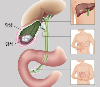 담낭염의 증상&amp;#44; 제거 수술&amp;#44; 치료 원인 좋은 음식 알아보기