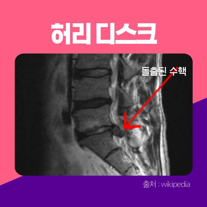 돌출된-수핵이-보이는-허리-디스크-사진