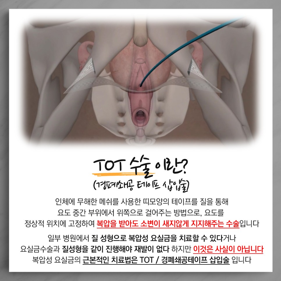 TOT 수술이란?