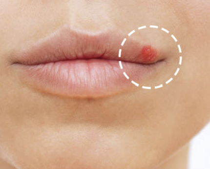 남성의 헤르페스 2형