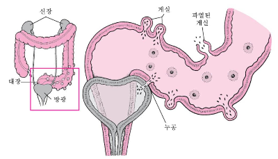 게실염