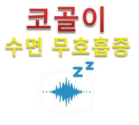  코골이 수면 무호흡증 치료방법