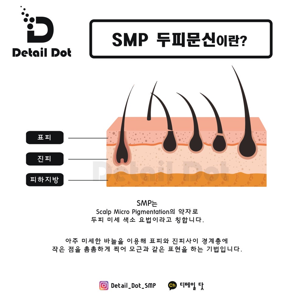 smp 두피문신 정의