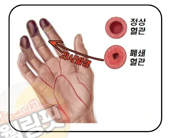 혈관이-폐쇄되면-혈액이-제대로-흐르지-못해-손끝이-썩게-됩니다.
