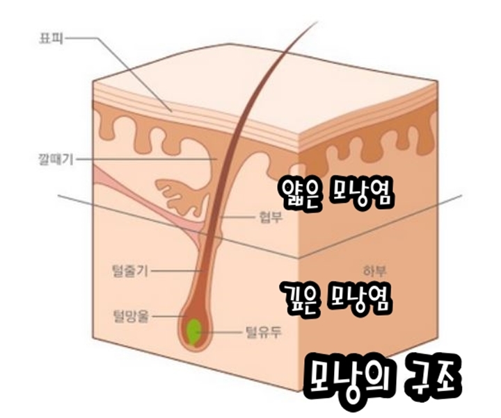 모낭의-구조