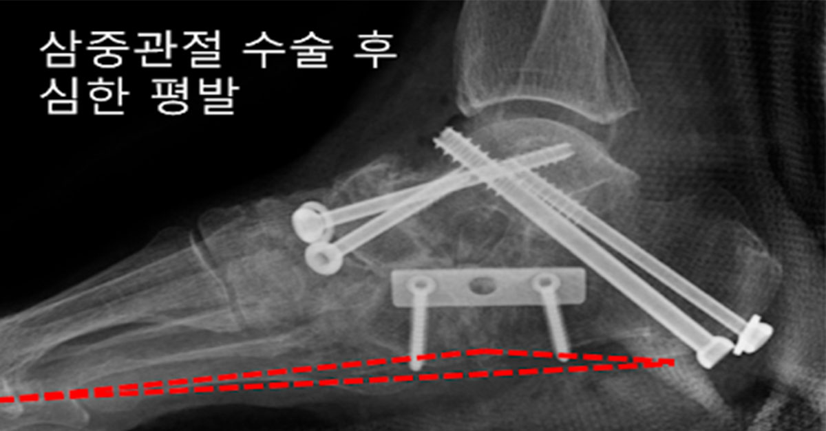  완전 심한 '평발'인 사람들이 받는다는 수술 ㄷㄷ