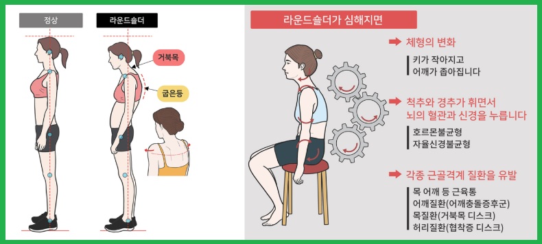 라운드 숄더 문제점