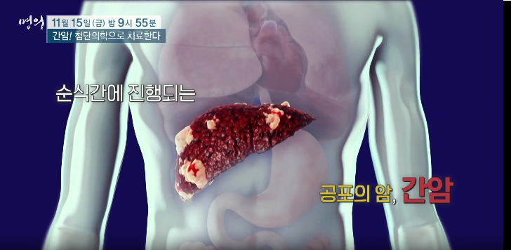 간암