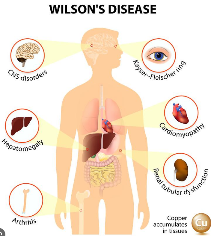 wilson&#39;s disease