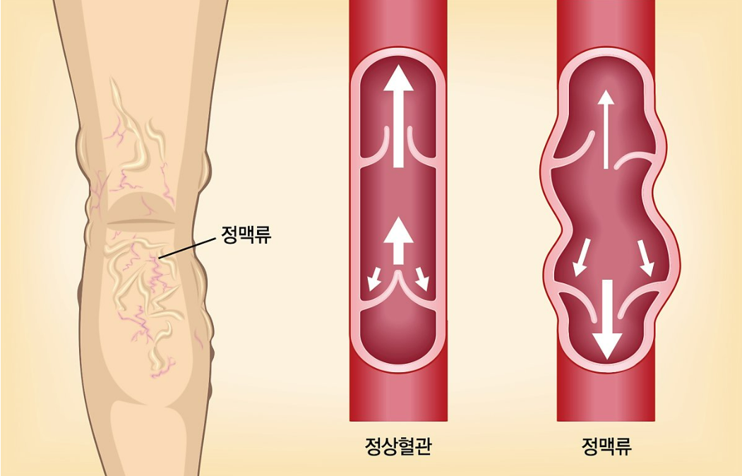 하지정맥류 원인과 증상&#44; 치료법 알아보기