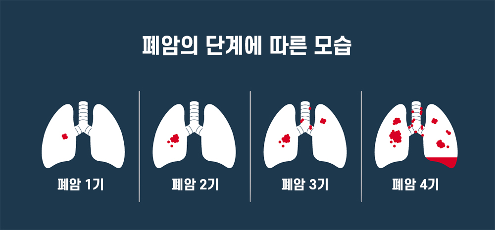 폐암 단계