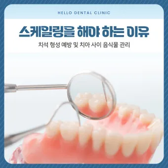 스케일링 후 양치 통증 음식_19