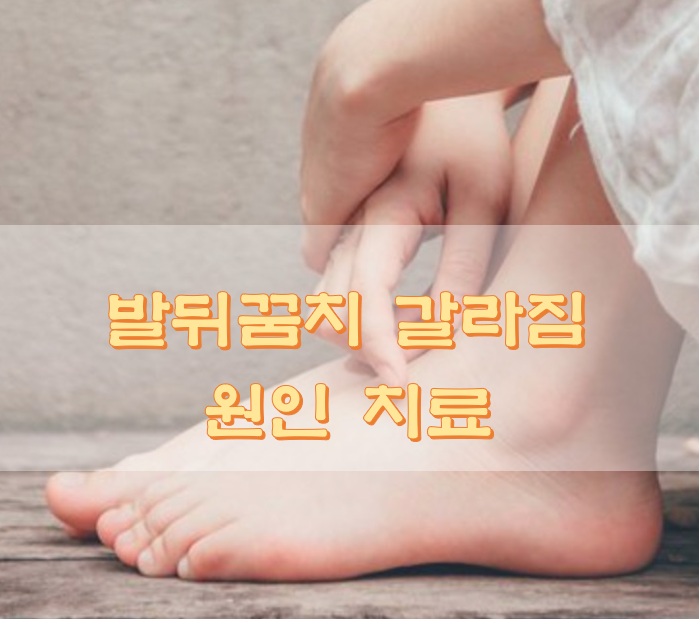  발뒤꿈치 갈라짐 원인 치료