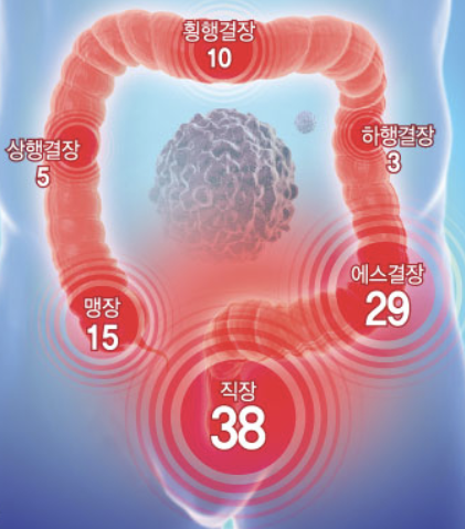 대장암 초기증상