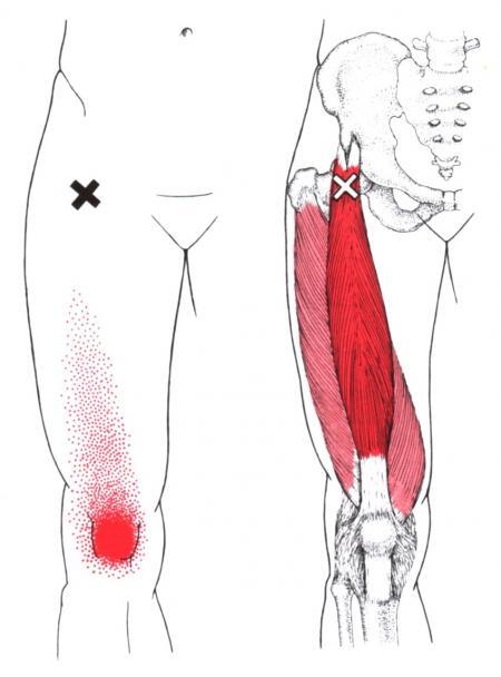 허벅지의 trigger point_대퇴직근