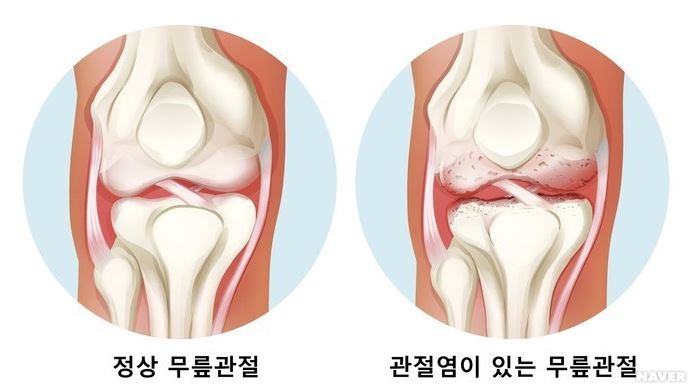 정상-무릎관절과-관절염이-있는-무릎관절