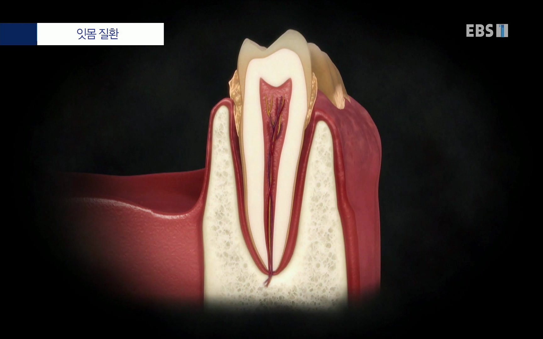EBS 명의 헬스케어 - TV - 교육의 중심 EBS치주염이 코로나로 소홀해진 구강관리가 치아를 더 망가트리고 위험하게 만들며, 증상이 없기 때문에 특히 더 조심하고 치은염 단계에서 진행되지 않도록 예방해야한다 정의원 교수님과 치_20220505_151708.836.jpg