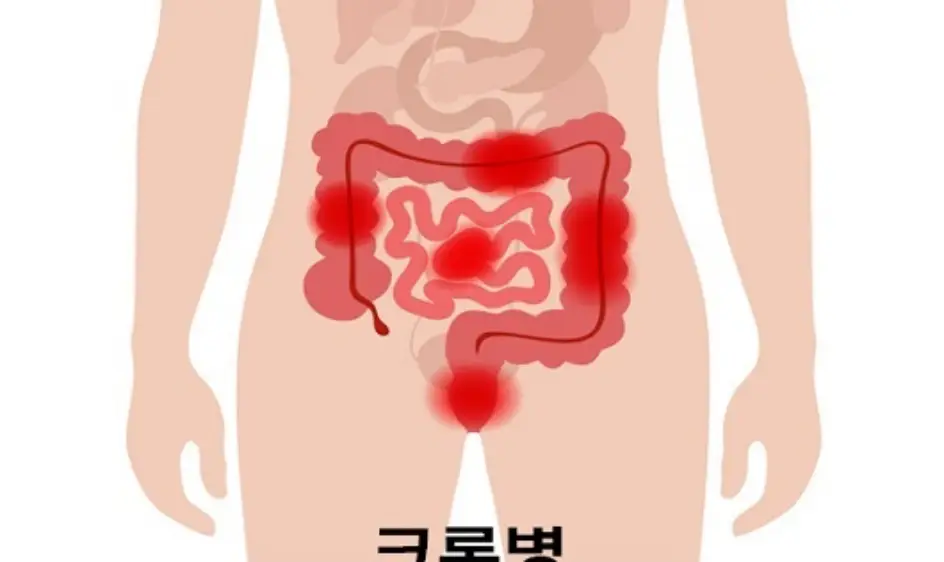 크론병 원인과 증상