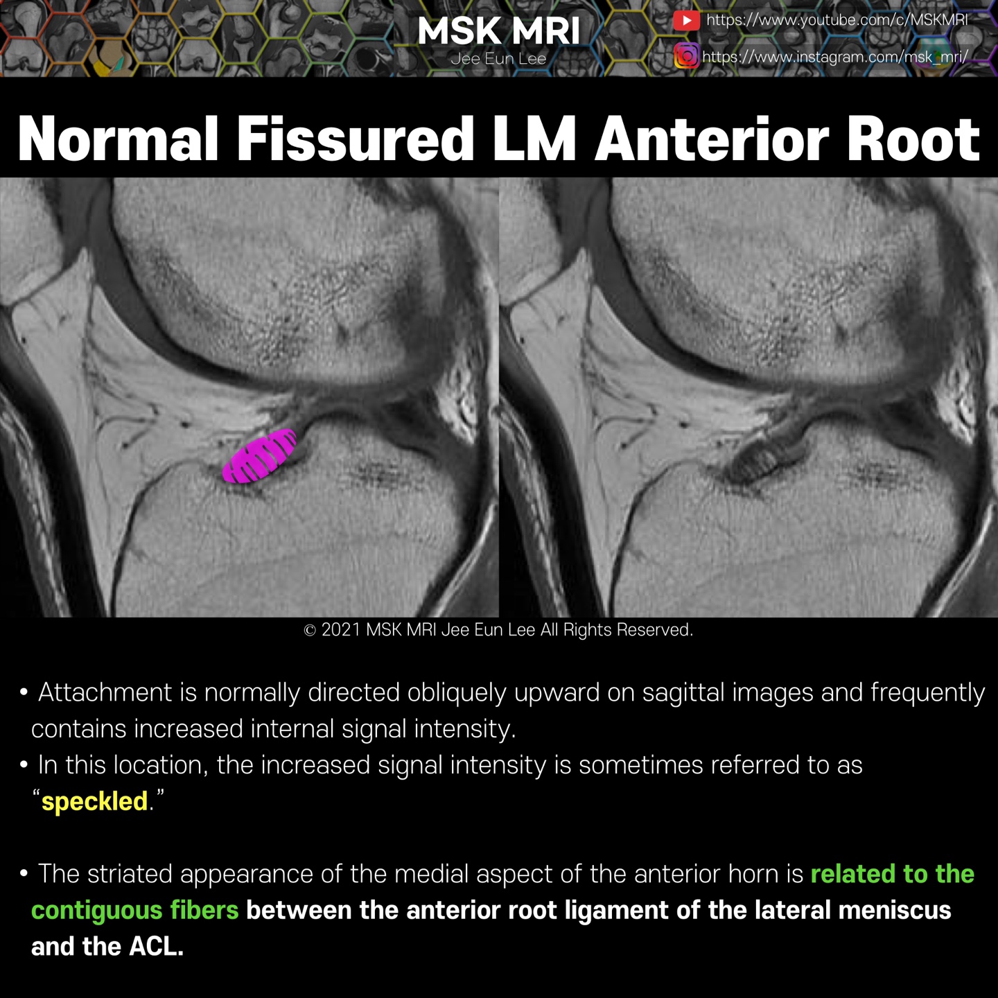 anterior root