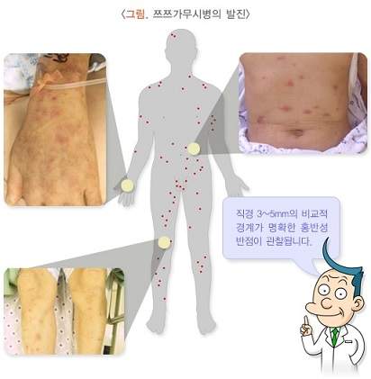 쯔쯔가무시병의 발진 출처-질병관리청