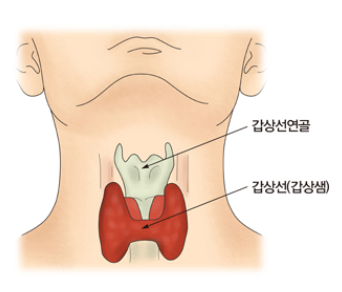 갑상선암