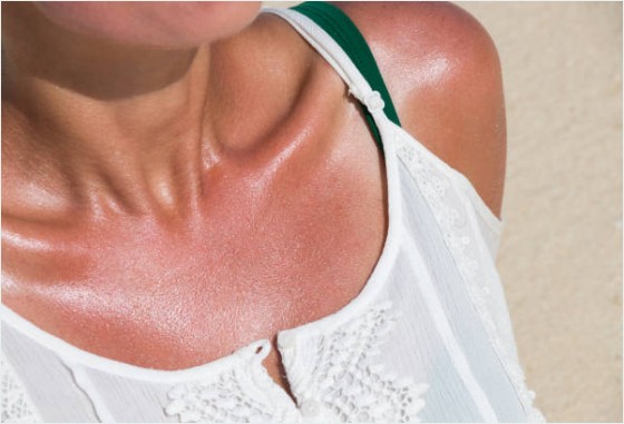 햇빛 알레르기 증상 및 원인과-없애는방법