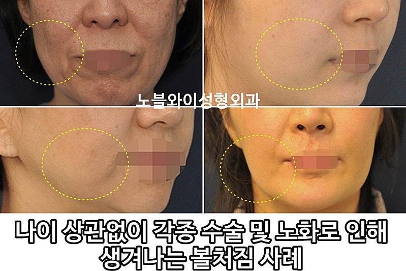 늘어진 피부를 조여주어 얼굴 처짐을 바로잡는 스킨케어법