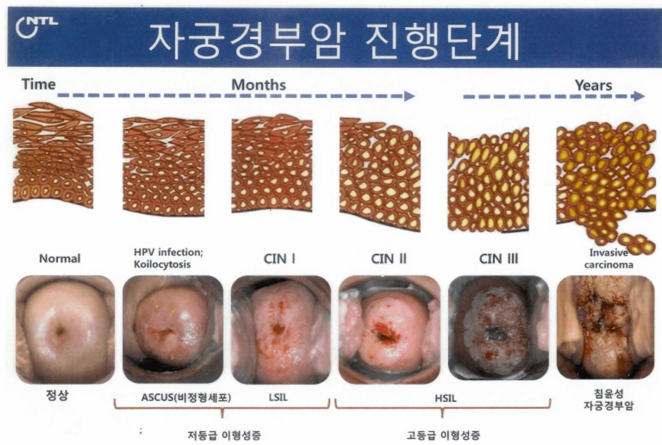 자궁경부암 예방접종 가격 자궁경부암 무료접종 대상