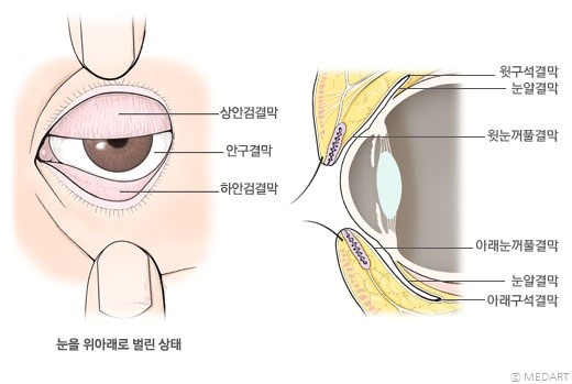 결막이완증 결막늘어짐 눈물