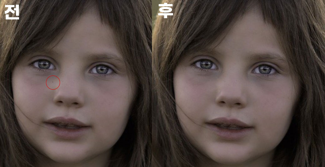 피부 잡티 제거 전 후 이미지