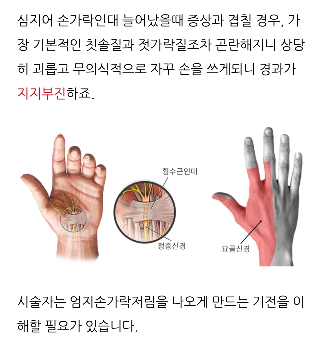 인대파열의 사진입니다