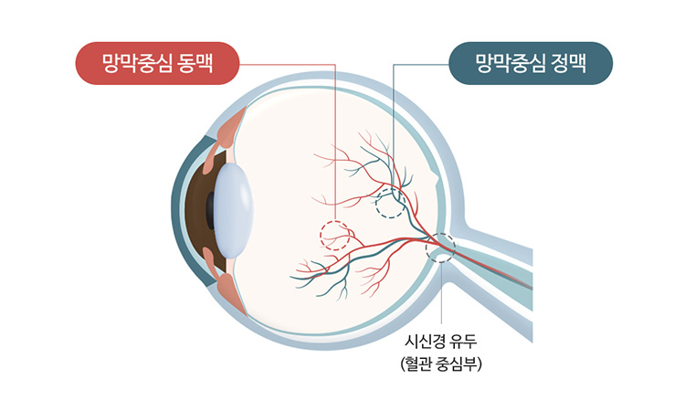 망막혈관폐쇄증