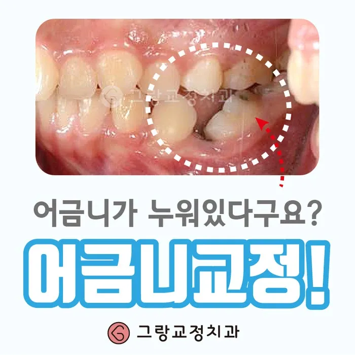 어금니 칫솔 사용법 선택방법 실사용 후기_2