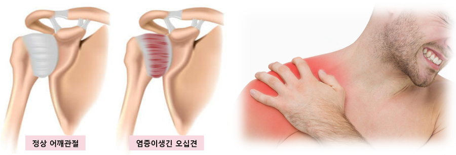 오십견수술비용7