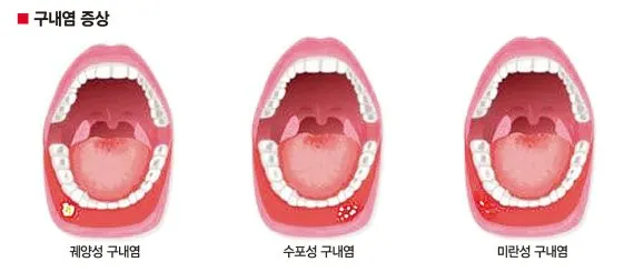 혓바늘이 돋는 이유