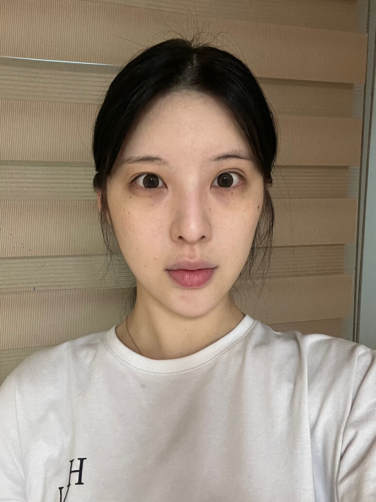  [눈재수술 +코재수술+얼굴(이마,)지방이식+턱끝전진술] 존예 에서 대존예로 ㄷㄷ -아름답tv-