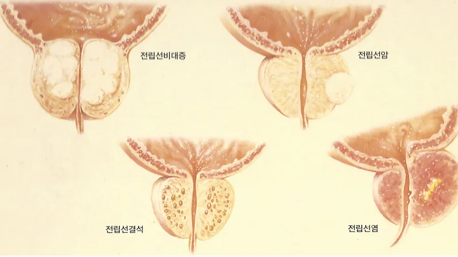 전립선염 증상