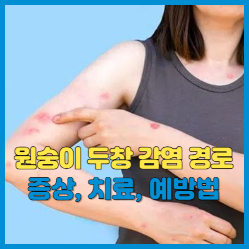 원숭이 두창