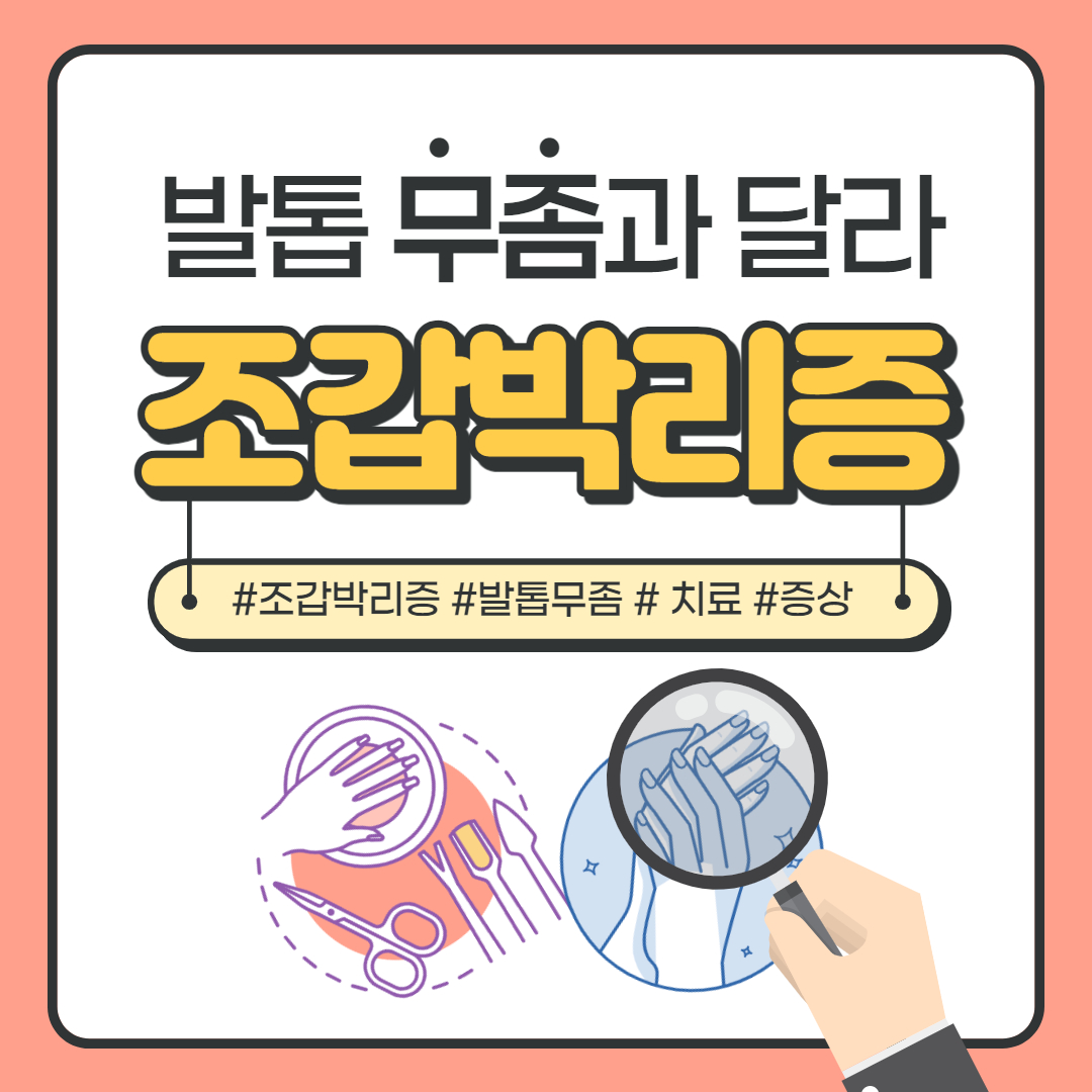  발톱무좀과 달라 발톱 조갑박리증