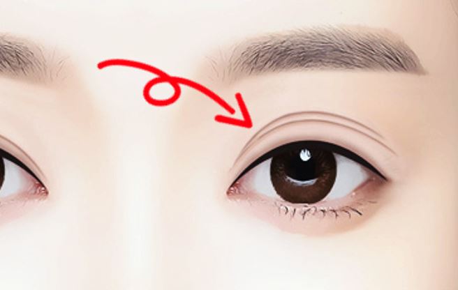  짝눈 교정 방법.. 안면비대칭 눈, 광대, 턱 교정으로 근본 원인 해결하자
