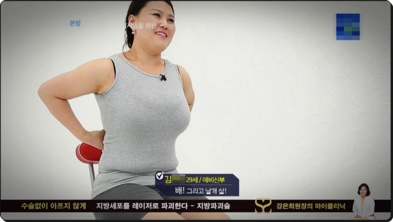 셀룰라이트 제거까지 지방파괴술 효과, 뱃살 다이어트부터 복부 6