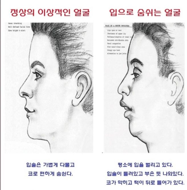 아데노이드 수술 아데노이드 비대증과 편도 비대