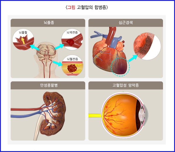 고혈압의 합병증 이미지
