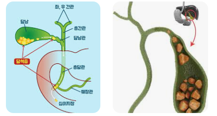 초음파 검사로 담석 진단