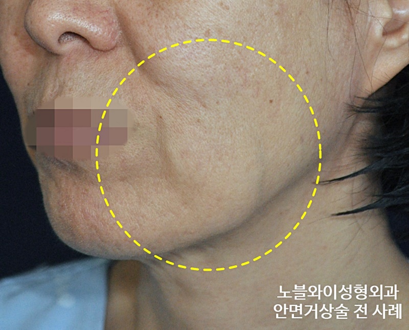  안면거상술회복기간 이런 과정을 거쳐