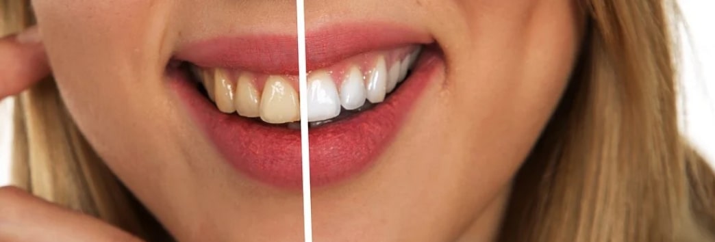 건강한 치아와 잇몸 비교 사진