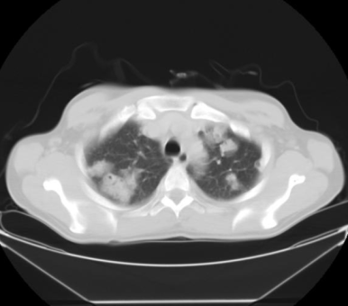 septic emboli의 흉부 CT 촬영