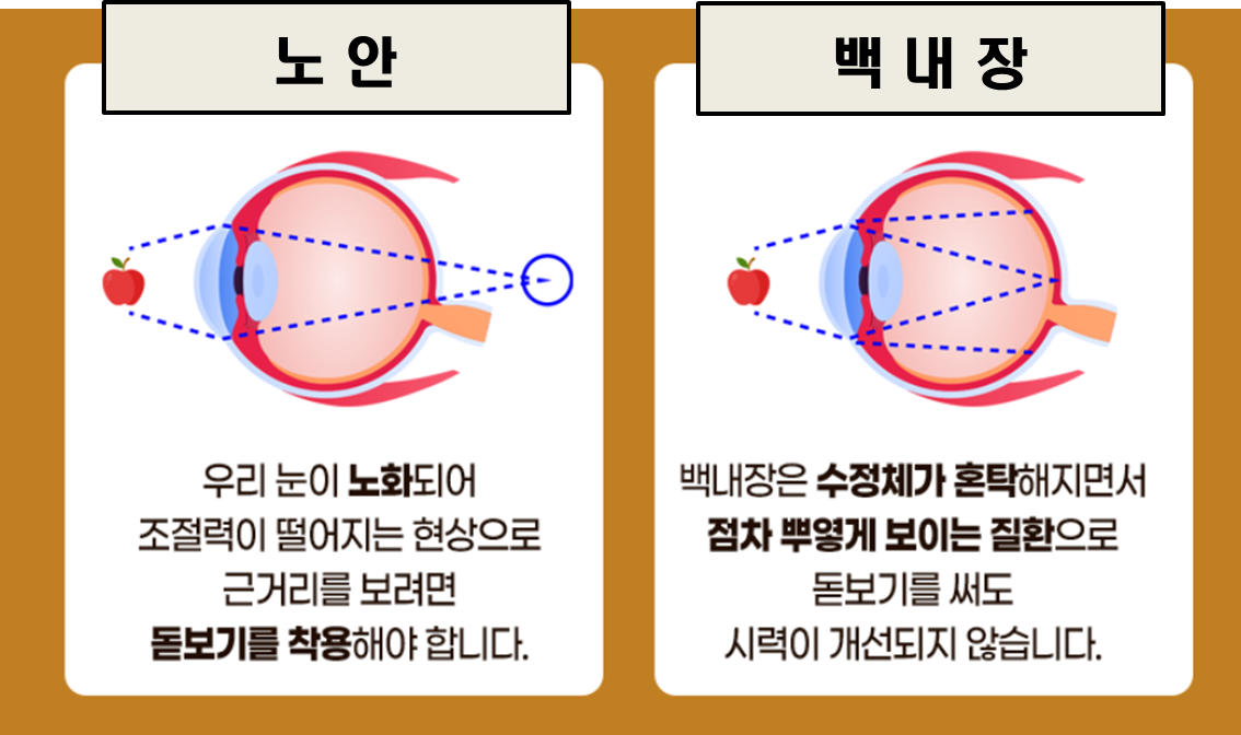 백내장과 노안