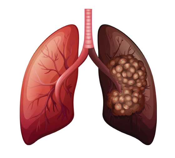 폐암 사진