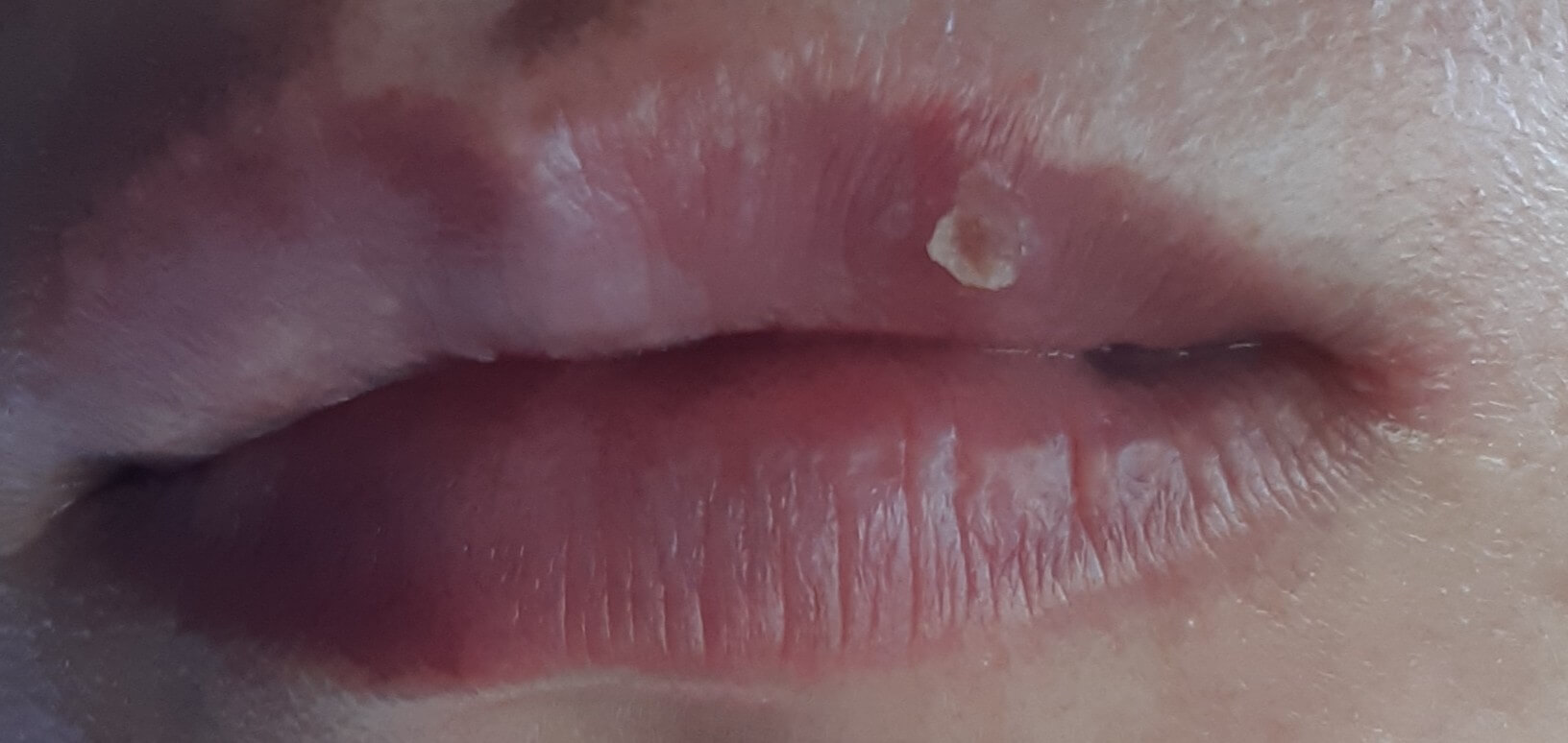 입술 왼쪽 끝 구각염 발생